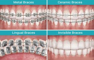 braces by type