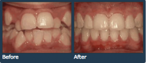 crowding teeth treatments