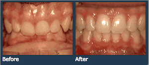 deep jaw overbite