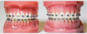home braces