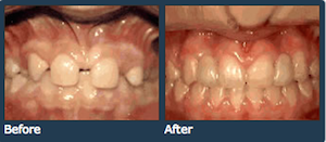 missing lateral teeth