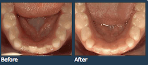 Non braces treatment