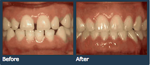 Space between teeth