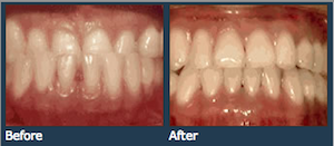 Underbite Patient